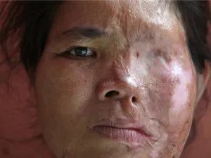 Acid violence is quite a common practice in many Far Eastern countries such as Cambodia, Sri Lanka, Indonesia