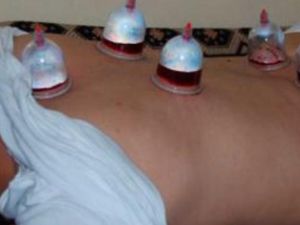 Cupping therapy is growing in popularity throughout Yemen's capital