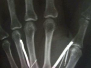 صورة اشعة ليد الخادمة السريلانكية تظهر وجود مسامير
