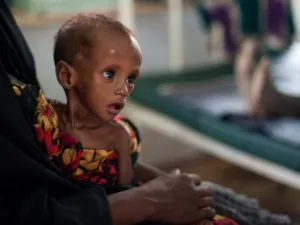 طفل صومالي يعاني من سوء تغذية حاد ينتظر في عيادة اطباء بلا حدود في دداب في كينيا،
