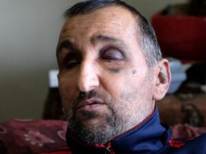 منذر مزهر واثار اللكمات بادية في وجهه