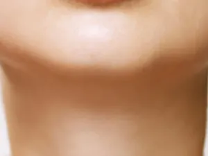 Because the skin on the neck is much thinner than that of other areas on the face, it ages more readily