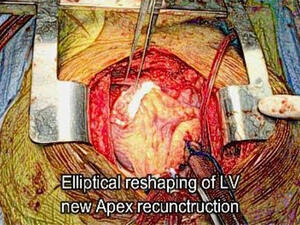 
The team was supported anaesthesia technicians and nursing staff and the operation was conducted using highly specialized technology such as Heart Lung machine. (Trade Arabia)
