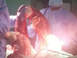  استئصال قولون متسمم ومتضخم ونادر