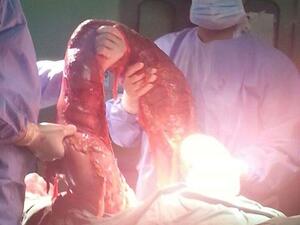  استئصال قولون متسمم ومتضخم ونادر