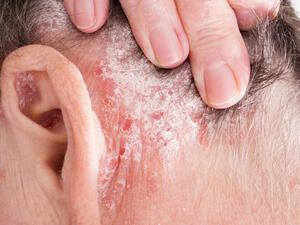 زيت جوز الهند لعلاج أعراض الصدفية !!