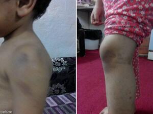 اثار الضرب على جسد الاطفال