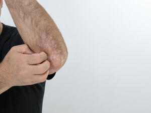 يتم وصف مشتقات فيتامين (د) في الكريمات والمراهم لعلاج الصدفية (shutterstock.com)