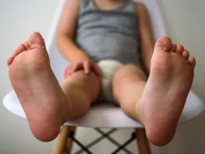 هناك بعض العلاجات التي تستخدم في تقليل حدة مرض الصدفية (shutterstock.com)
