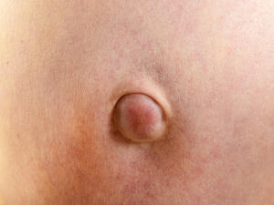 أعراض الفتق انتفاخ واضح وظاهر أسفل الجلد في منطقة البطن أو الفخذ