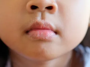 يشكل تشقق الشفاه وجفافها عند الأطفال لهم الكثير من الألم (shutterstock.com)
