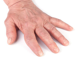 من أعراض أورام الأصابع صعوبة ثنيها