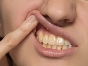إصفرار الأسنان أكثر المشاكل التي نعاني منها وتسبب الخجل (shutterstock.com)