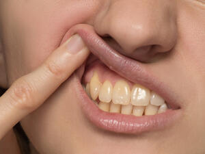 إصفرار الأسنان أكثر المشاكل التي نعاني منها وتسبب الخجل (shutterstock.com)