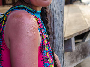 يلعب فيتامين د دورًا هامًا في شفاء الحروق والجروح (shutterstock.com)