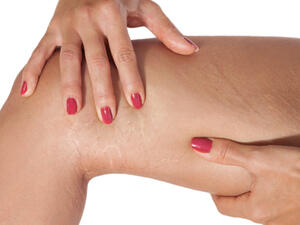 علامات التمدد هي شكل من أشكال الندب غير المؤذية على الجلد (shutterstock.com)
