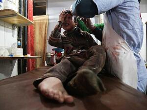 طفل سوري أصيب بجروح جراء القصف العنيف على الغوطة