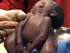 قرر والدا الطفلين منح المولودين للمراكز الطبية من أجل الأبحاث العلمية