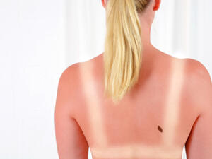 تنشأ سرطانات الجلد عقب التعرض لأشعة شمس شديدة

