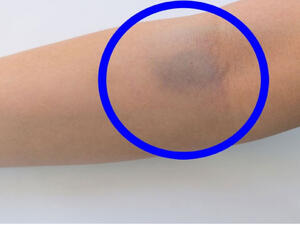 من أسباب ظهور بقع زرقاء في الجسم تناول بعض أنواع الأدوية، مثل الأسبرين