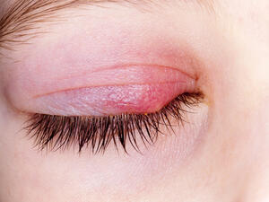 شحاذ العين من أكثر الإصابات المزعجة لدى المصابين بها
