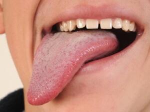 من أسباب بلع اللسان حدوث هبوط في نسبة السكر في الدم