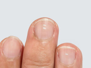 ظهور بقع بيضاء على الظفر غير معروفة السبب يتطلب فحصًا للدم 