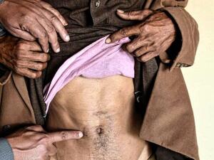 المنظمة اليمنية لمحاربة تجارة الأعضاء وثقت أكثر من ألف حالة تجارة أعضاء منذ سنة 2012