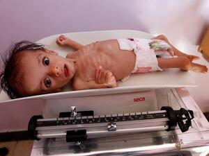 A malnourished child receives treatment at a hospital in the Yemeni capital, (Sana'a Mohammed Huwais/AFP)