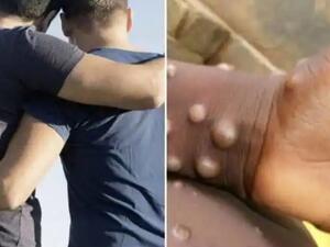 14 ألف مصاب بجدري القرود حول العالم معظمهم مثليون جنسيا