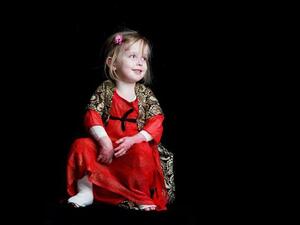  Iranian Children with EB (Twitter)