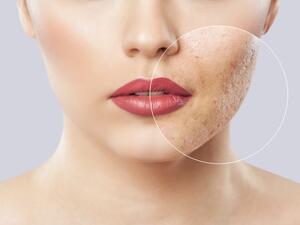 تجنب شرب المياه الغازية والمشروبات المحفوظة فهي من أهم أسباب ظهور حب الشباب