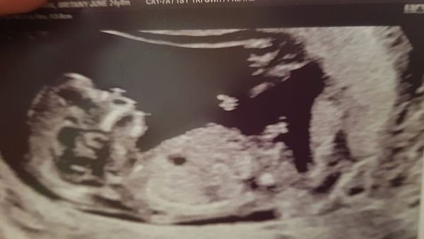 The couple were shocked to see what they believe is a guardian angel (top right) in the 12-week scan. (Daily Mail)
