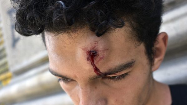 A demonstrator injured after receiving a pellet shot from riot police in Valparaiso, on the sixth straight day of protests which erupted over a now suspended hike in metro ticket prices, on October 23, 2019. A four-year-old child was killed during the latest round of protests against economic inequality in Chile, raising the death toll to 18 as unions launched a general strike on Wednesday. Raul Goycoolea / AFP