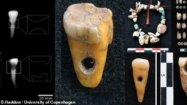 The group of researchers believe their samples are the earliest example of artificially modified human teeth in the region. (University of Copenhagen/ Scott D. Haddow)
