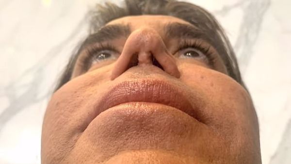 Sammy is meeting with the Botched doctors to see if they will be able to give him his old nose back. 'I would love to breathe better and for my nose to look better,' he says (dailymail)  
