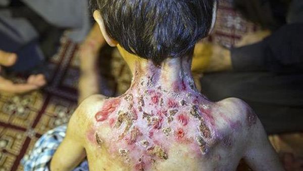  Iranian children who are suffering from EB (Twitter)