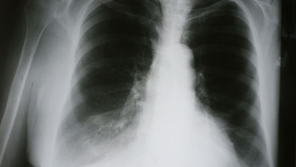 Xray of Chronic Obstructive Pulmonary Disease (Shutterstock)	