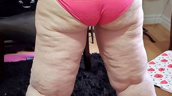 Katie Baker, 31, from Ontario, Canada, is trying to raise £112,000 for life- changing surgery to remove 20 litres of fat from her large legs (dailymail)