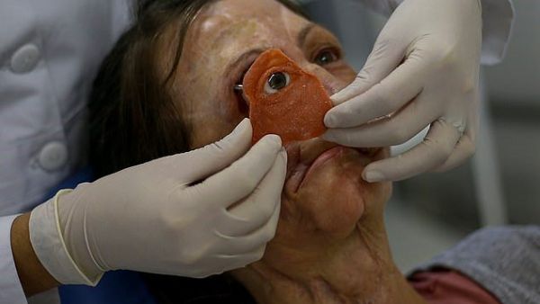 Denise Vicentin, 52, has had part of her face reconstructed using smartphones and 3D printers (AFP)
