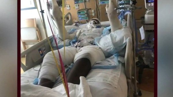 Burned teen warns against YouTube fire challenge. (Twitter)