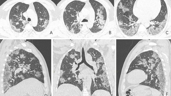 Shocking X-ray images show what coronavirus does to victims' lungs (Twitter)