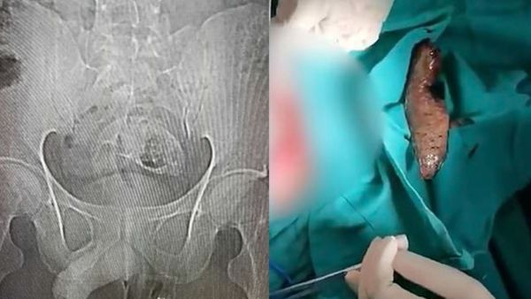 إزالة سمكة بلطي نافقة من بطن مريض