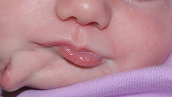 This South Carolina Baby Girl was Born With a Second Mouth (Twitter)