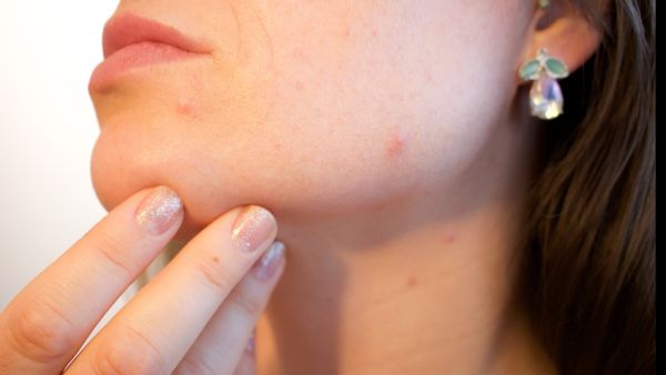 طبيب البوابة: 5 أعشاب لعلاج حب الشباب