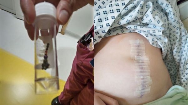 تحدي "تيك توك" يتسبب في استئصال الزائدة الدودية لطفلة وجزء من أمعائها