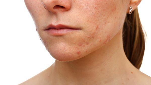 حفر الوجه ندبات جلدية تظهر على سطح بشرة الوجه وخاصة على الوجنتين ومنطقة الذقن