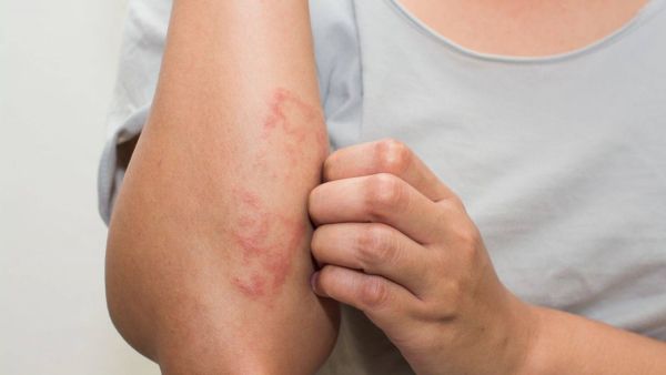 7 أطعمة يجب تجنبها عند الأطفال المصابين بالأكزيما