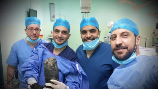 استخراج كتلة شعر من معدة مريضة في الأردن تزن 6 كلغ