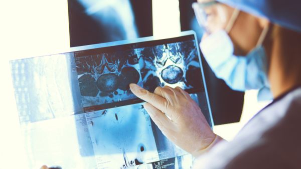 A new Lancet Oncology Commission finds that annual cancer deaths in sub-Saharan Africa (SSA) could reach 1 million by 2030